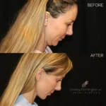 Before and after extended deep plane facelift, structural neck lift, endoscopic brow lift, lower lid blepharoplasty, fat grafting, and lip lift.