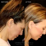 Before and after extended deep plane facelift, structural neck lift, endoscopic brow lift, upper and lower lid blepharoplasty, and fat grafting