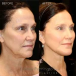 Before and after extended deep plane facelift, structural neck lift, lateral brow lift, transcutaneous lower lid blepharoplasty, laser resurfacing, and fat grafting.
