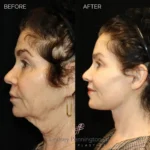Before and after total facial rejuvenation: deep plane facelift, structural neck lift, endoscopic brow lift, upper/lower blepharoplasty, lip lift, fat grafting, laser resurfacing, and earlobe reduction.