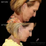 Before and after extended deep plane facelift, structural neck lift, endoscopic brow lift, upper and lower blepharoplasty, fat grafting with nano fat, lip lift, and laser resurfacing.