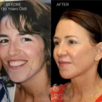 Before and after extended deep plane facelift, structural neck lift, endoscopic brow lift, open lower lid blepharoplasty, laser resurfacing, and PRP injections.