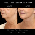 deep plane facelift necklift before and after