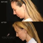 Before and after extended deep plane facelift, structural neck lift, endoscopic brow lift, lower lid blepharoplasty, fat grafting, and lip lift.
