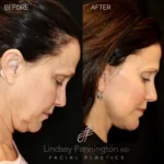 Before and after extended deep plane facelift, structural neck lift, lateral brow lift, transcutaneous lower lid blepharoplasty, laser resurfacing, and fat grafting.