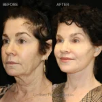 Before and after total facial rejuvenation: deep plane facelift, structural neck lift, endoscopic brow lift, upper/lower blepharoplasty, lip lift, fat grafting, laser resurfacing, and earlobe reduction.