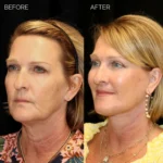 Before and after extended deep plane facelift, structural neck lift, endoscopic brow lift, upper and lower blepharoplasty, fat grafting with nano fat, lip lift, and laser resurfacing.
