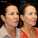 Before and after extended deep plane facelift, structural neck lift, endoscopic brow lift, open lower lid blepharoplasty, laser resurfacing, and PRP injections.
