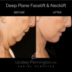 deep plane facelift necklift before and after
