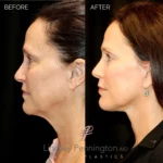 Before and after extended deep plane facelift, structural neck lift, lateral brow lift, transcutaneous lower lid blepharoplasty, laser resurfacing, and fat grafting.