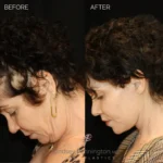 Before and after total facial rejuvenation: deep plane facelift, structural neck lift, endoscopic brow lift, upper/lower blepharoplasty, lip lift, fat grafting, laser resurfacing, and earlobe reduction.