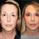 plastic surgery before and after photo