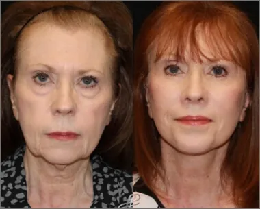 plastic surgery before and after photo