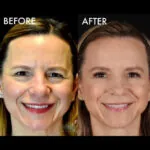 Blepharoplasty before and after photo