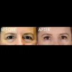 Blepharoplasty before and after photo