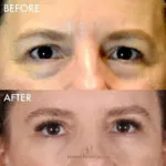 Blepharoplasty before and after photo