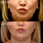botox before and after photo
