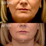 Dermal Filler before and after photo