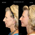 Facelift before and after photo