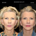 Facelift before and after photo