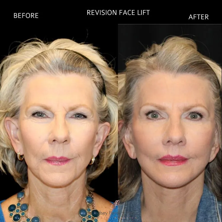 Facelift before and after photo