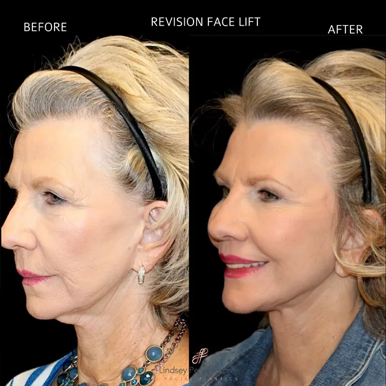 Facelift before and after photo