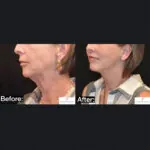 Facelift before and after photo