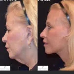 Facelift before and after photo