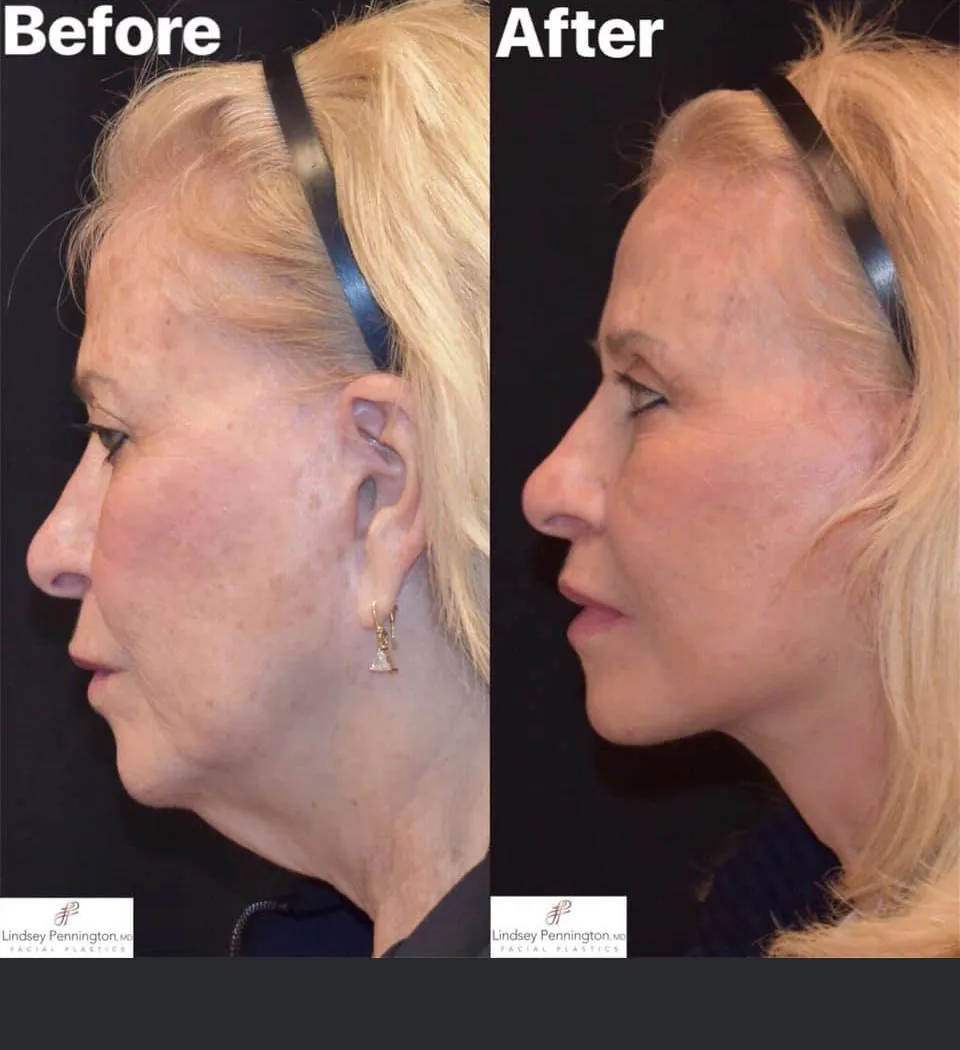 Facelift before and after photo
