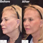 Facelift before and after photo