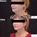 Facelift before and after photo