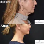 Facelift before and after photo