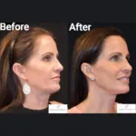Facelift before and after photo