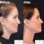 Facelift before and after photo