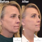 Facelift before and after photo