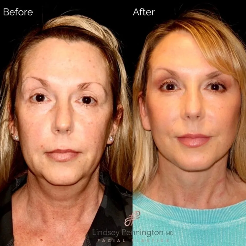 Facelift before and after photo