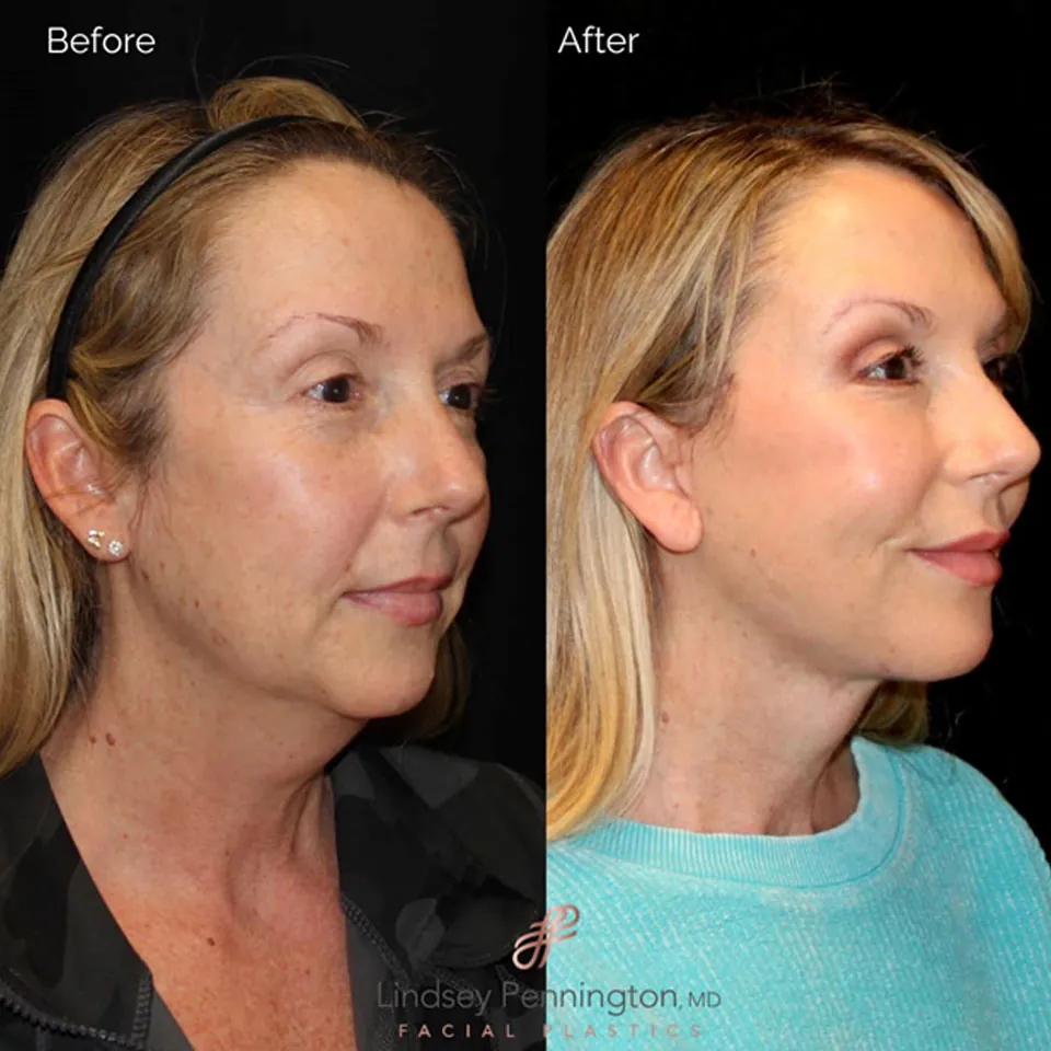 Facelift before and after photo