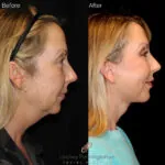 Facelift before and after photo