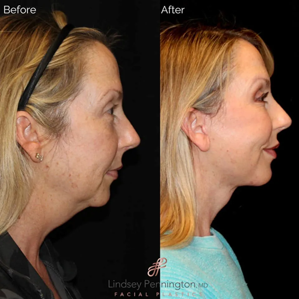 Facelift before and after photo