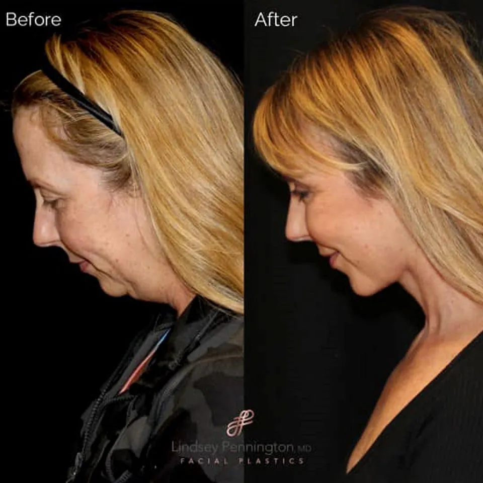 Facelift before and after photo