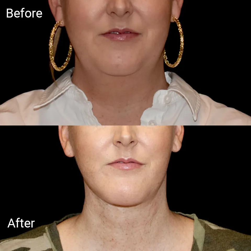 Facelift before and after photo