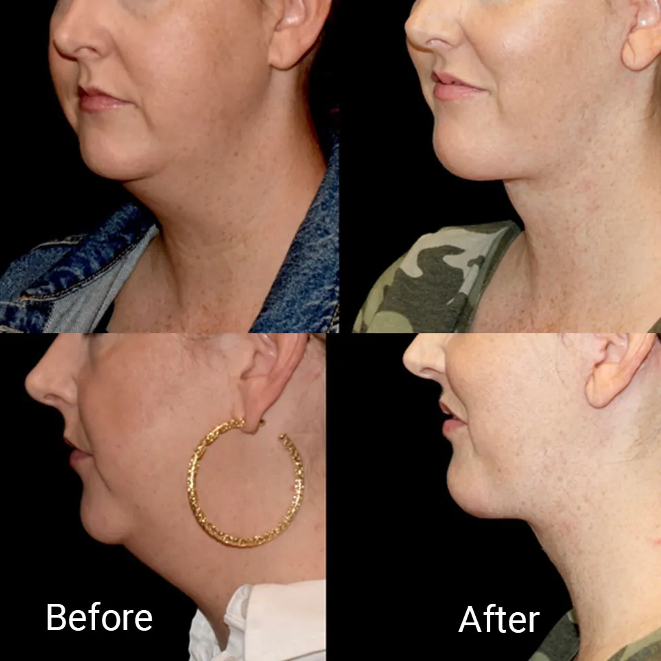 Facelift before and after photo