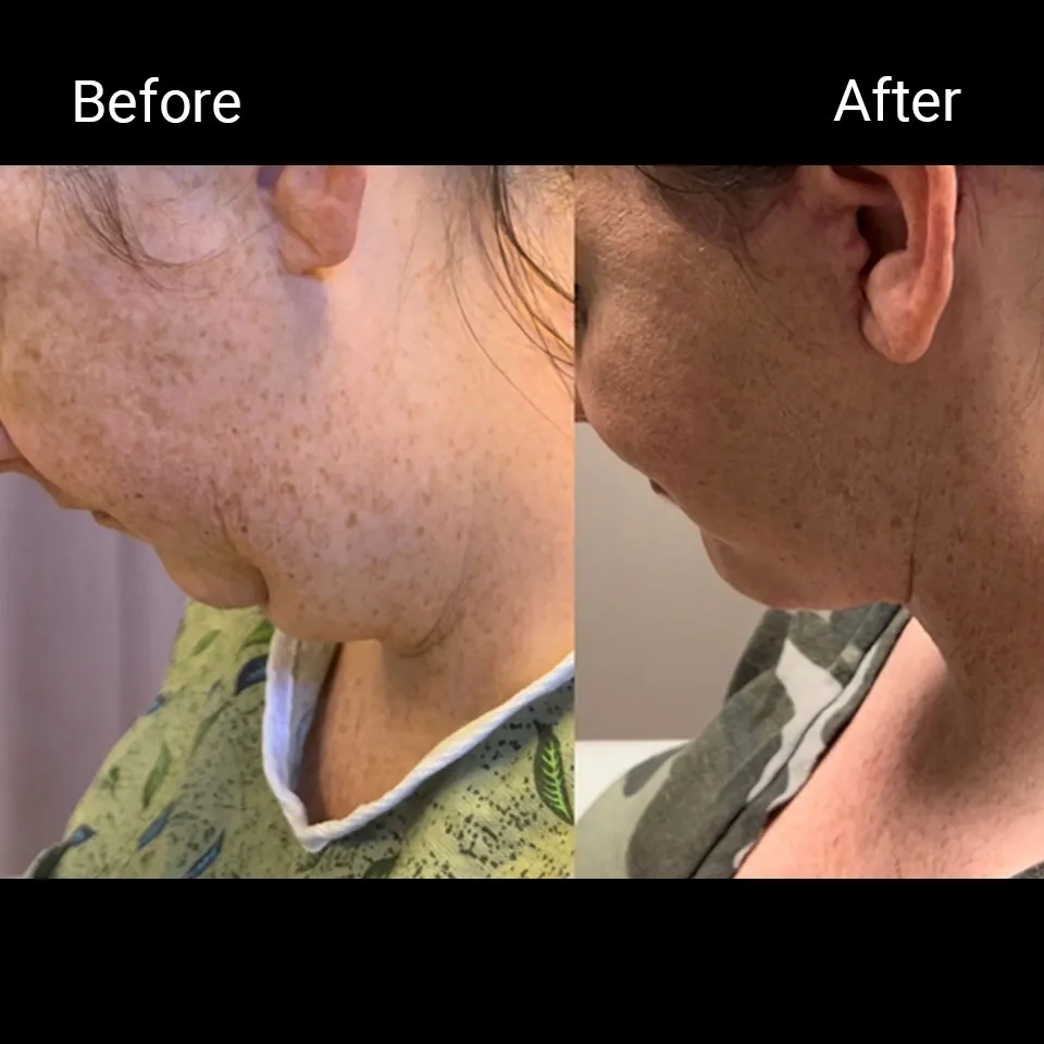 Facelift before and after photo