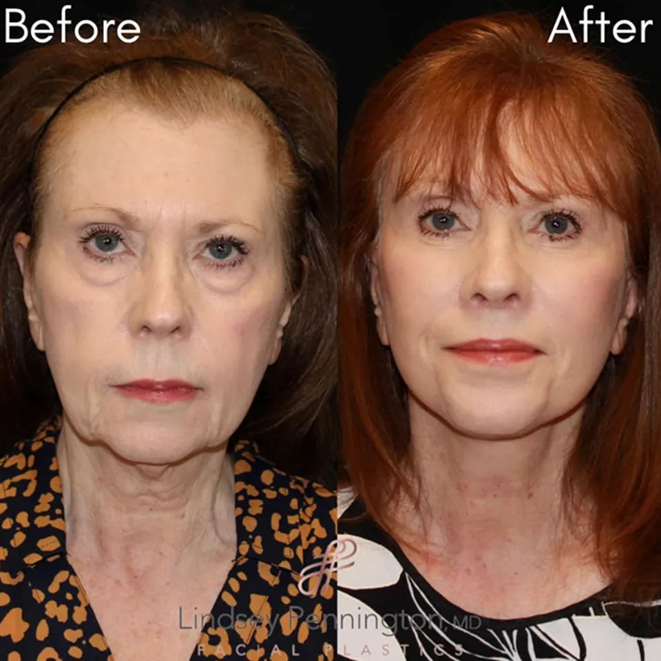 Facelift before and after photo