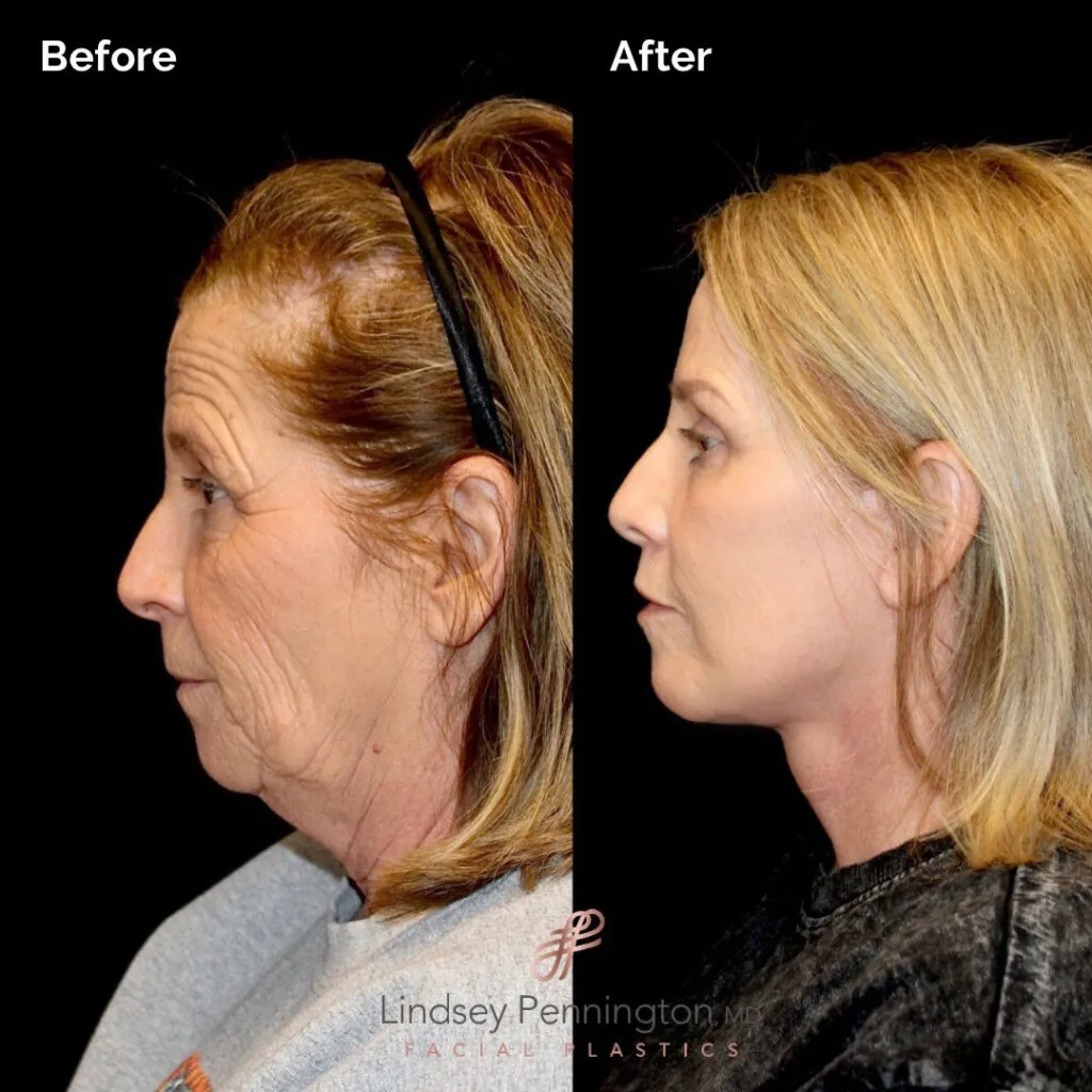 Facelift_slide-31-2img Facelift before and after photo