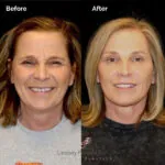 Facelift before and after photo