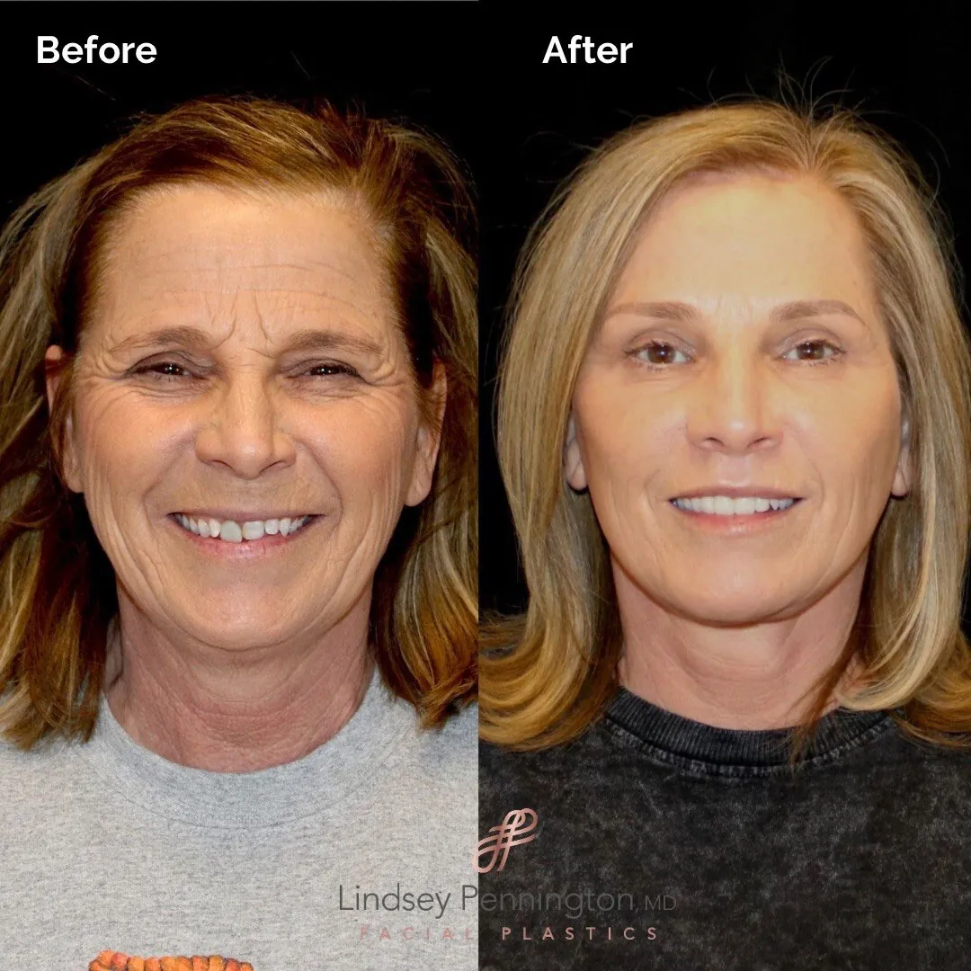 Facelift before and after photo
