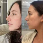 Facelift before and after photo