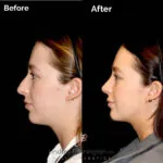 Facelift before and after photo
