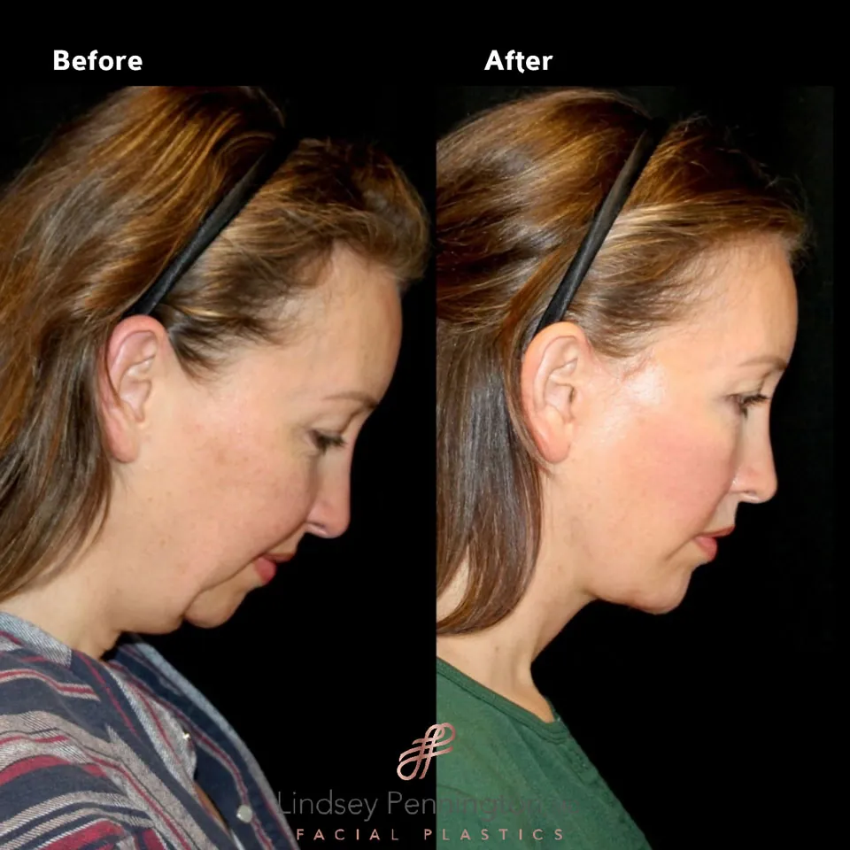 Facelift before and after photo